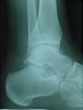 Foot X-Ray